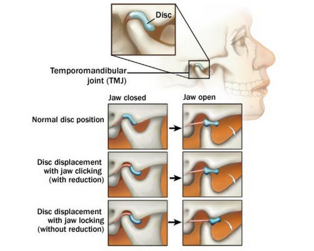 TMJ Issues Explained Body Of Life Health Centre