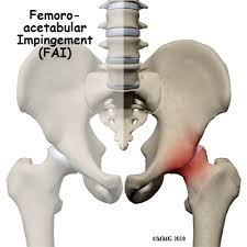 FAI Syndrome